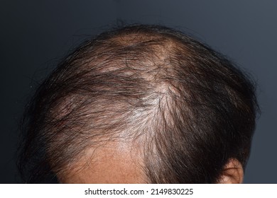 3,761 Sparse hair Images, Stock Photos & Vectors | Shutterstock