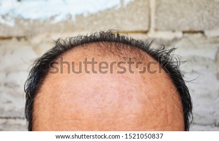 Thinning or sparse hair, male pattern hair loss in Southeast Asian