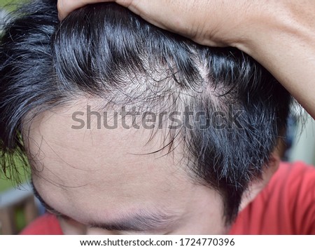 Thinning or sparse hair, male pattern hair loss and bald forehead in Southeast Asian, Chinese Burmese young man. Early hair losing at young age. Lateral view.