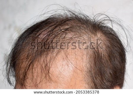Thinning or sparse hair, male pattern hair loss in Southeast Asian, Chinese elder man.