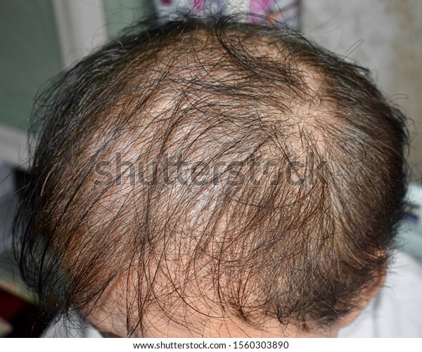 Thinning or sparse hair, male pattern hair\
loss in Southeast Asian, Chinese elder\
man.