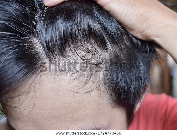 Thinning or sparse hair, male\
pattern hair loss and bald forehead in Southeast Asian, Chinese\
Burmese young man. Early hair losing at young age. Lateral\
view.