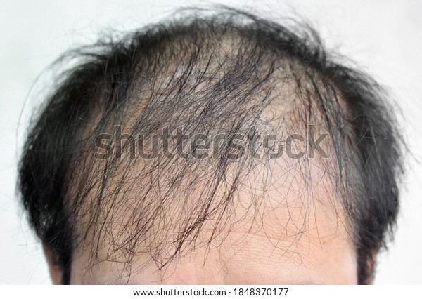Thinning or sparse hair, male pattern hair loss in\
Southeast Asian, Chinese elder man.  Forehead of old man. Isolated\
on white.