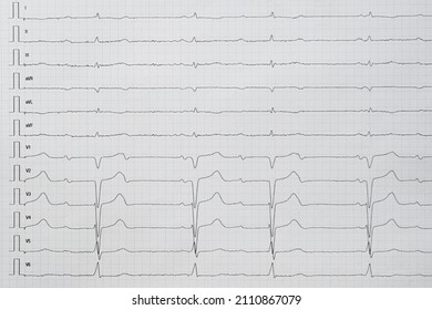 Third Degree AV Block With Complete Atrioventricular Dissociation 