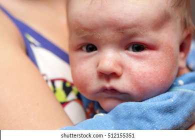 This is eczema on face of newborn 
