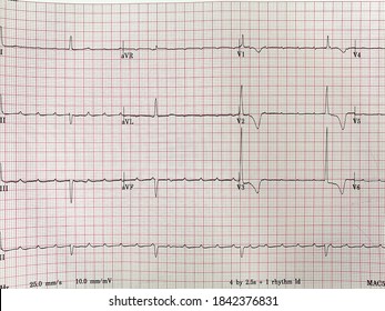 This Ekg Paper Show Complete Heart Stock Photo (Edit Now) 1842376831