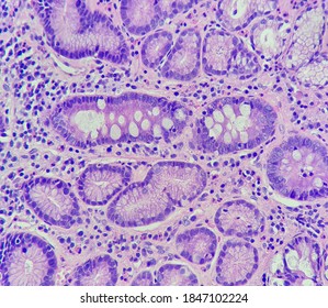 Metaplasia Images, Stock Photos & Vectors | Shutterstock