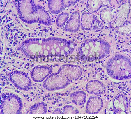 This gastric mucosa reveals focal intestinal metaplasia, magnification 400x, photo under microscope