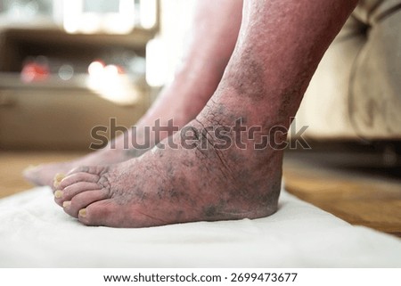 This image captures a pair of swollen feet and ankles, illustrating the physical effects of edema amid the familiar comforts of a home environment and personal care.