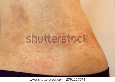 This macro shot captures a human flank suffering from a severe cutaneous eruption. Warm illumination highlights the textured epidermis, revealing widespread erythema and raised welts. Symbolizing physiological distress and allergic reactions, this clinical visual is ideal for healthcare portals and dermatology publishing.