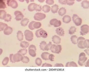 This Is Plasmodium Falciparum Early Stage By Microscopic .causing Malaria Infection.