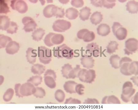 This is plasmodium falciparum early stage by microscopic .causing malaria infection.
