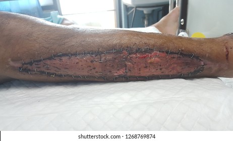 This Is A Skin Graft At Leg.