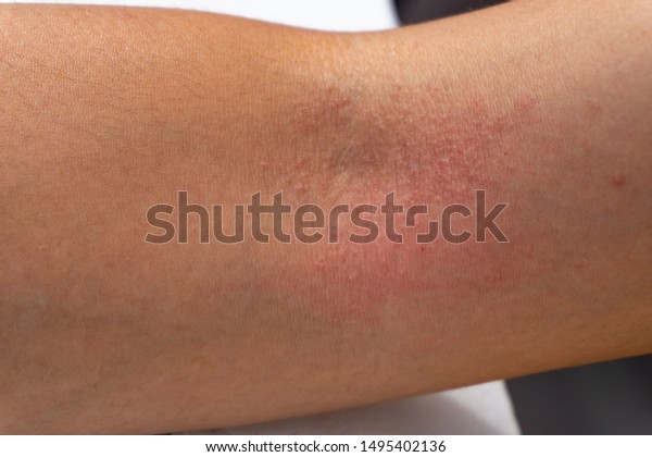 Tiny Red Itchy Spots On Skin Jameslemingthon Blog