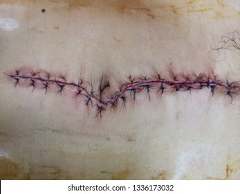 
This surgical wound caused by abdominal surgery of surgical patients. Such as intestinal obstruction, Peptic ulcer perforate. Surgical wounds that sew the skin with Nylon 3/0 is non absorbable.