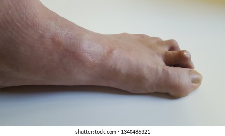 This Is What A Hammer Toe Looks Like.