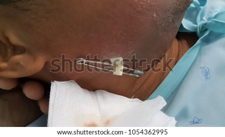 this is a wound of buccal abscess which post incision and drainage. It has penrose drain  with brooch sterlie.