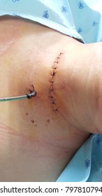 This is a wound of thyroidectomy at neck which suture by nylon and on radivac drain.