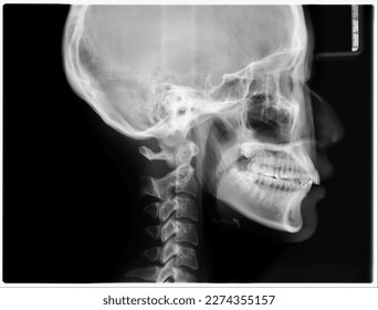 This X-ray image is an essential tool for dental education and cephalometric analysis for orthodontics treatment.It provides detailed information about the skull, teeth, jaws, and other structures.