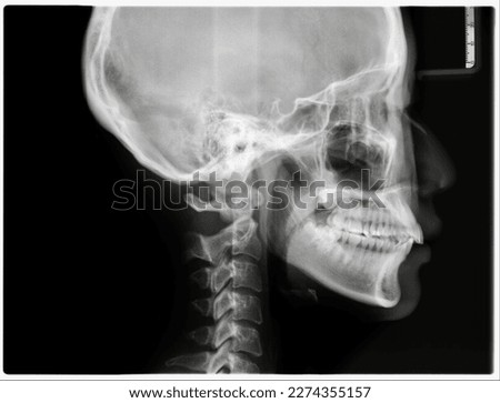 This X-ray image is an essential tool for dental education and cephalometric analysis for orthodontics treatment.It provides detailed information about the skull, teeth, jaws, and other structures.