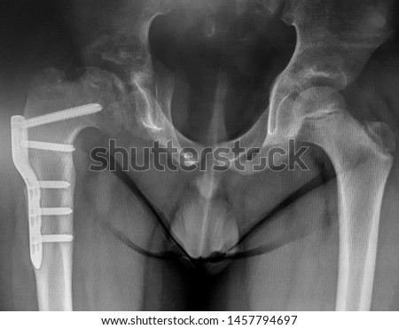 This x-ray is shown corrective osteotomy of proximal femur in Legg Calve Perthes Disease (LCPD) patient and femoral head subluxation 1 year later.
