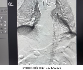 Thoracic Endovascular Stent Graft Was Deployed At Descending Aorta During TEVAR Procedure.