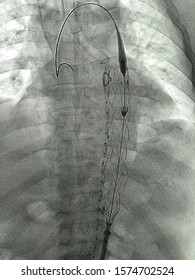 Thoracic Endovascular Stent Graft Was Deployed At Descending Aorta During TEVAR Procedure.