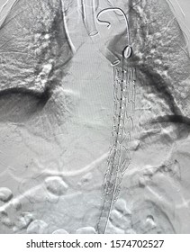 Thoracic Endovascular Stent Graft Was Deployed At Descending Aorta During TEVAR Procedure.