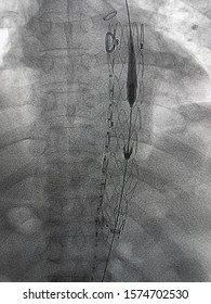 Thoracic Endovascular Stent Graft Was Deployed At Descending Aorta During TEVAR Procedure.