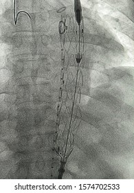 Thoracic Endovascular Stent Graft Was Deployed At Descending Aorta During TEVAR Procedure.