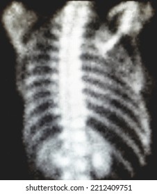 Thoracic Nuclear Medicine Bone Scan - Normal Image