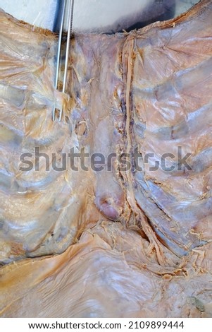 Thoracic wall (internal view) demonstrated the internal thoracic vessels and related structures. Gross anatomy lab cadaver.