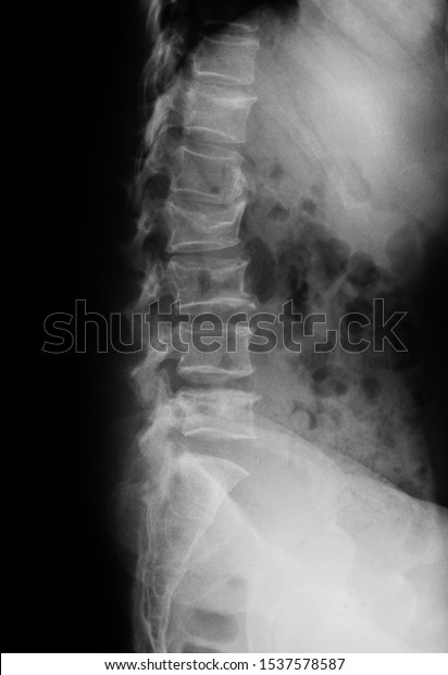 Thoracolumbar Spinetl Spine Xray Showing Spinal Stock Photo Edit Now