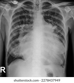 Thorax is another name for the chest. While AP usually stands for antero-posterior (front-back). The term AP thorax is commonly used in radiological examinations, for example when an X-ray is taken.