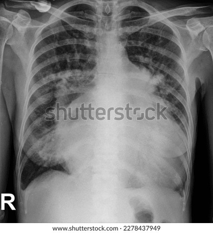 Thorax is another name for the chest. While AP usually stands for antero-posterior (front-back). The term AP thorax is commonly used in radiological examinations, for example when an X-ray is taken.