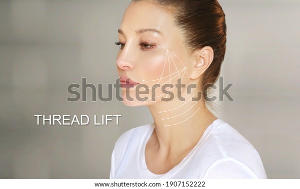 Thread Lift ,markup, thread-lift procedure\
for facial rejuvenation.