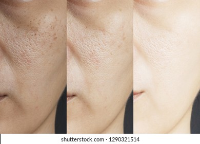 three pictures compared effect Before and After treatment. skin with problems of freckles , pore , dull skin and wrinkles before and after treatment to solve skin problem for better skin result - Shutterstock ID 1290321514
