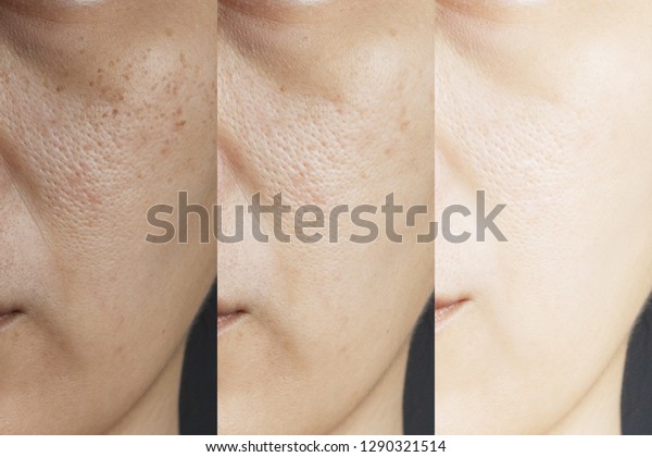 three pictures compared effect Before and After\
treatment. skin with problems of freckles , pore , dull skin and\
wrinkles before and after treatment to solve skin problem for\
better skin result