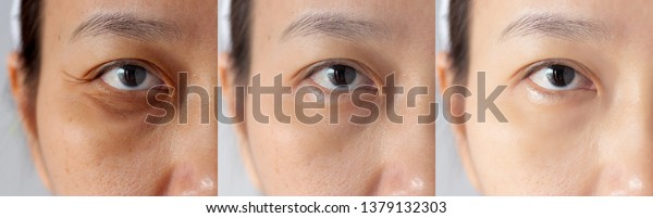 three pictures compared effect Before and After\
treatment. under eyes with problems of dark circles ,puffiness and\
wrinkles periorbital before and after treatment to solve skin\
problem for better skin