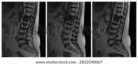Three sequential sagittal T2 weighted MRI slices showing different paramedian and central views of the lumbar and lumbosacral spine.