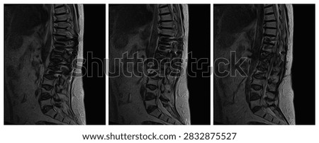 Three sequential sagittal T2 weighted MRI slices from a postoperative examination of the lumbar and lumbosacral spine in a patient with documented osteoporosis.