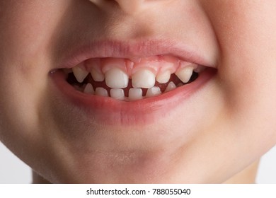 Three year old boy smiling, showing calf's teeth, mouth macro close up