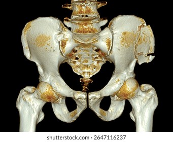 Three-dimensional computed tomography (CT) scan image of the human pelvis demonstrating a fracture of the left iliac wing. 
Useful in trauma assessment, orthopedic diagnosis, and surgical planning.