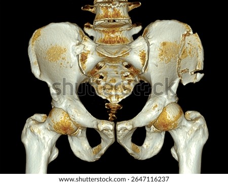 Three-dimensional computed tomography (CT) scan image of the human pelvis demonstrating a fracture of the left iliac wing. 
Useful in trauma assessment, orthopedic diagnosis, and surgical planning.
