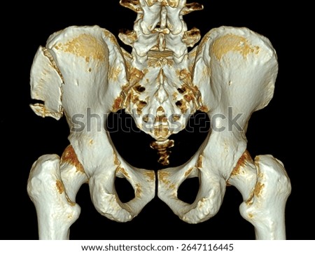 Three-dimensional computed tomography (CT) scan image of the human pelvis demonstrating a fracture of the left iliac wing. 
Useful in trauma assessment, orthopedic diagnosis, and surgical planning.