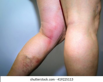 Thrombophlebitis in human leg. Painful inflammation of the leg veins. Medical issue