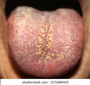 Thrush On The Tongue. Geographic Tongue. Candidiasis.