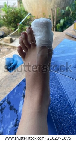 Thumb foot injury nail plate