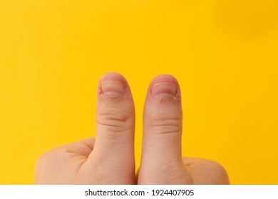 Thumbs Up Injured Or Bad Finger Nail On Yellow Background. Close Up Thumb With Bad Manicure Close Up