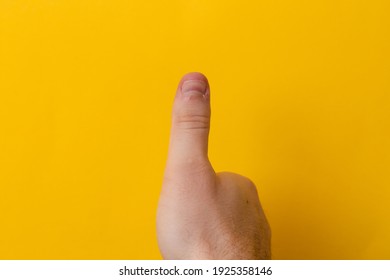 Thumbs Up Injured Or Bad Finger Nail On Yellow Background. Close Up Thumb With Bad Manicure Close Up